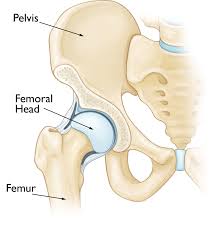 Osteonecrosis of the Hip - OrthoInfo - AAOS